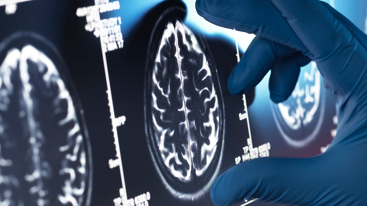 Brain Scans Reveal a Striking Similarity Between Schizophrenia And Bipolar Disorder