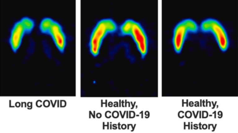 Long COVID Linked to Lasting Damage in The Brain's Dopamine System