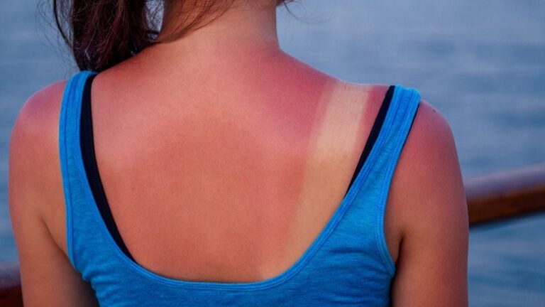 Bad News: Just One Intense Sunburn Really Can Be 'Life-Changing' 