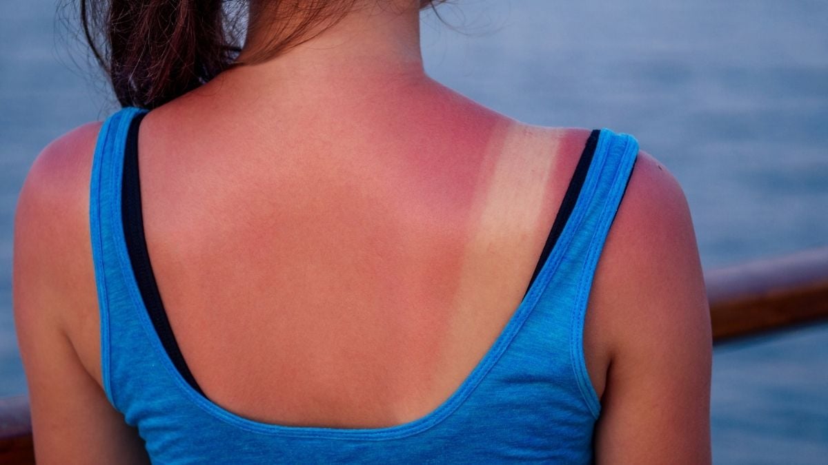 Bad News: Just One Intense Sunburn Really Can Be 'Life-Changing' 