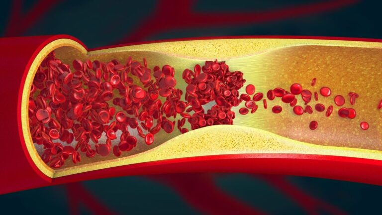 Scientists Find 'Ominous' Signs of Artery Damage in Nearly 8 in 10 Young Adults