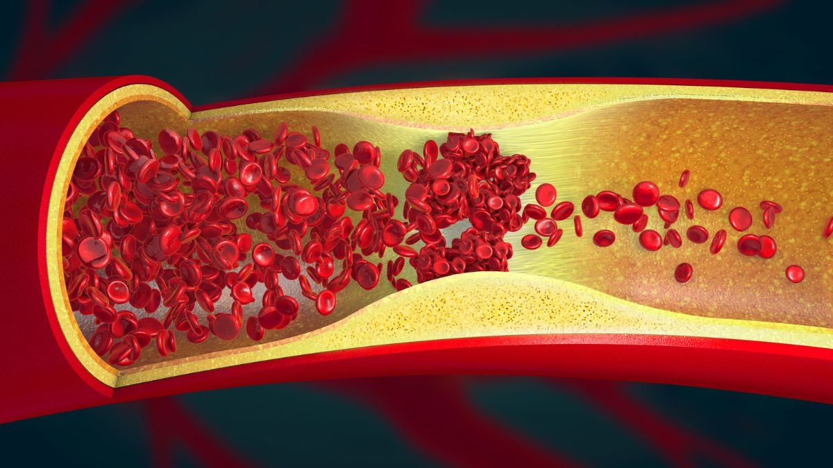 Scientists Find 'Ominous' Signs of Artery Damage in Nearly 8 in 10 Young Adults