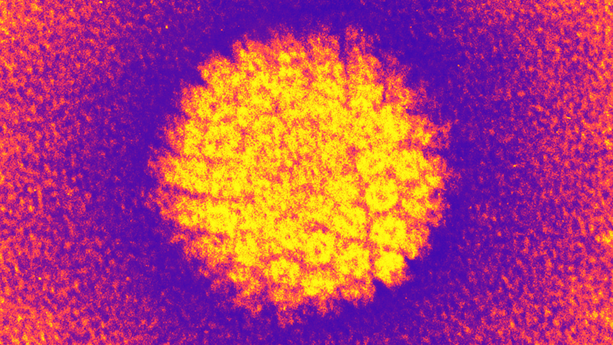 As cervical cancer rates fall, HPV is causing more throat and mouth cancers in men — why?
