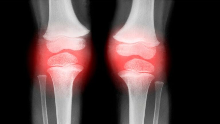 Breakthrough To Restore Aging Joints Could Help Treat Osteoarthritis