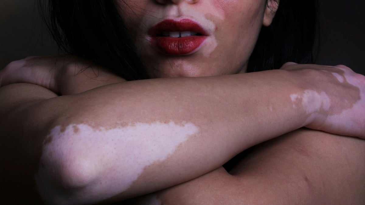 This Once-Daily Pill Helps The Skin Regain Its Color in People With Vitiligo