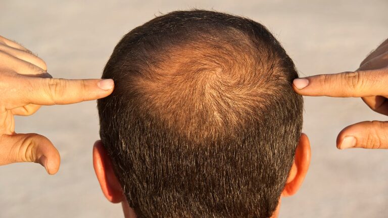 GLP-1 Drugs Could Nudge Some Men Toward Hair Loss, Study Suggests