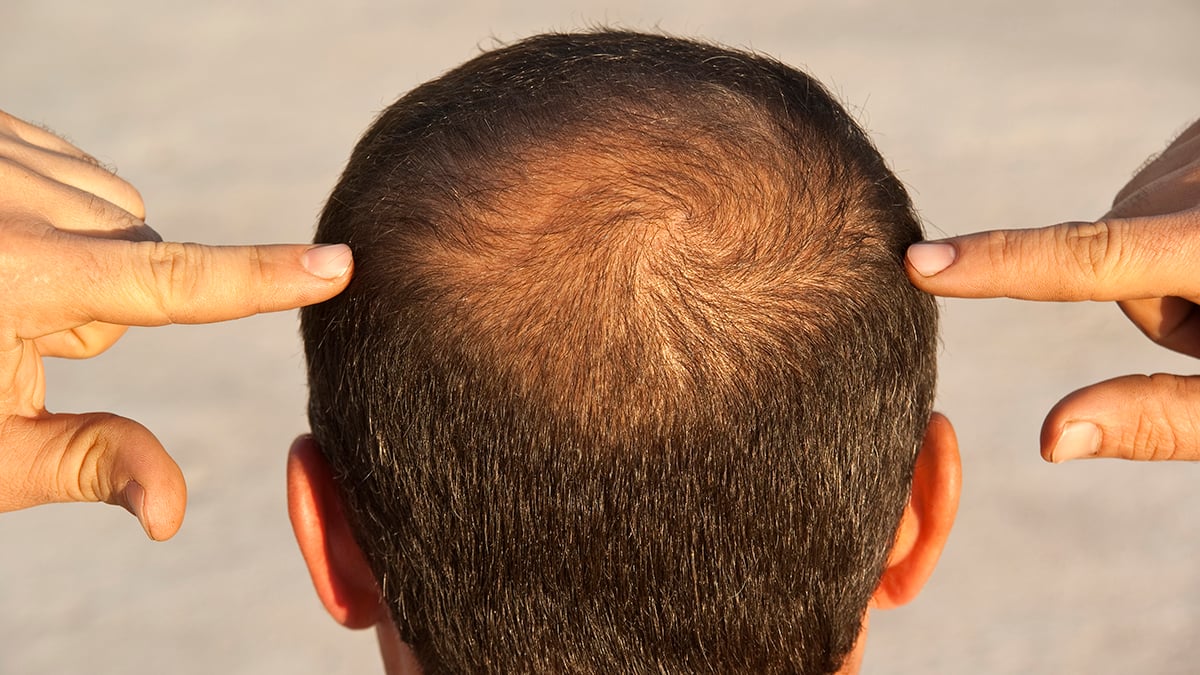 GLP-1 Drugs Could Nudge Some Men Toward Hair Loss, Study Suggests