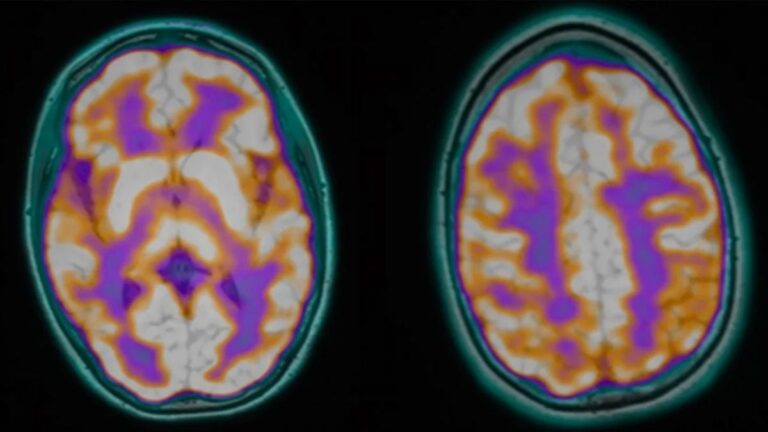 After These Young People Died, Postmortems Found an Unnerving Parasite Link