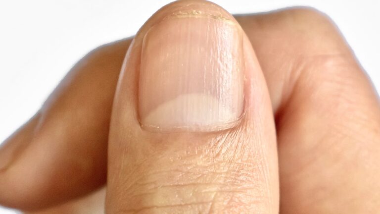 This Subtle Change to Your Fingernails Can Be a Sign of Hidden Disease