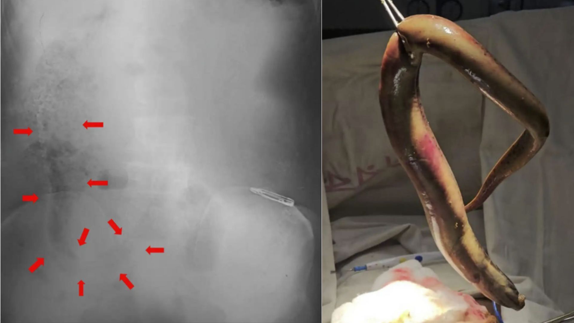 Diagnostic dilemma: Fisher's colon punctured by eel that snuck in through his rectum