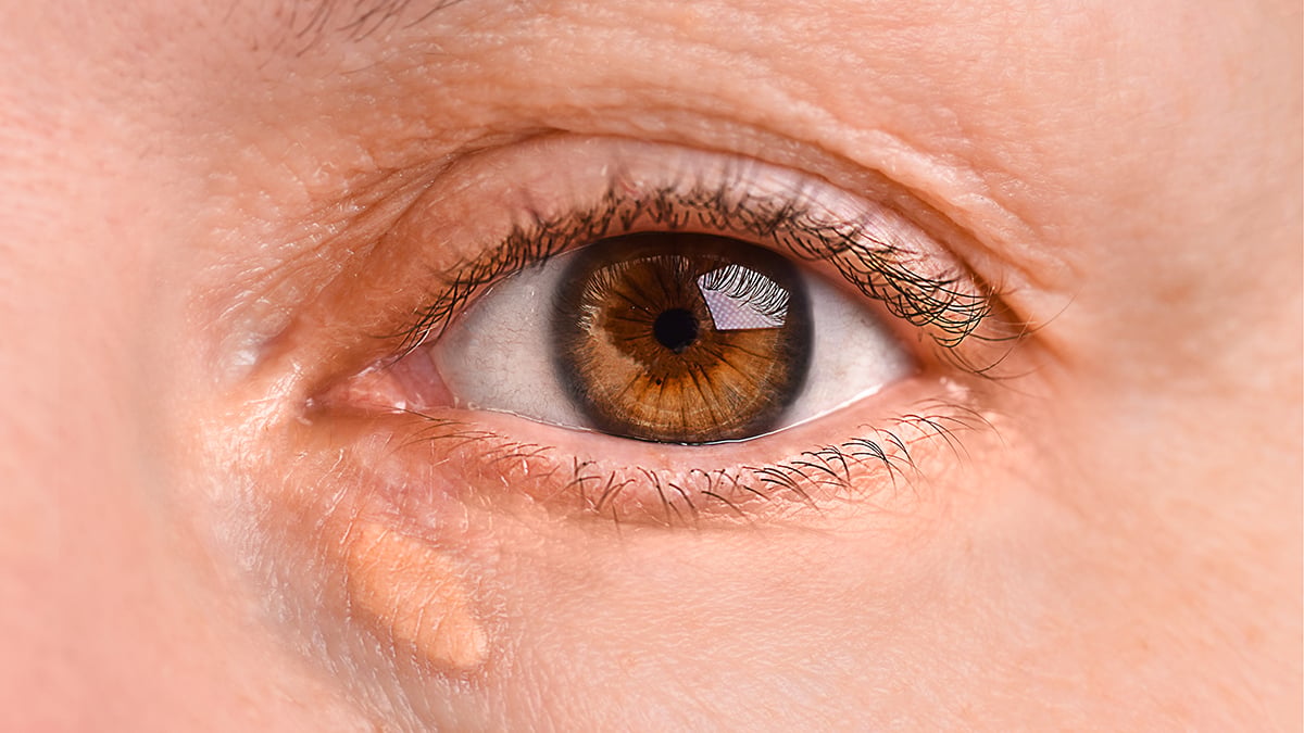 A Warning Sign of Heart Attack And Stroke May Show Up on Your Face